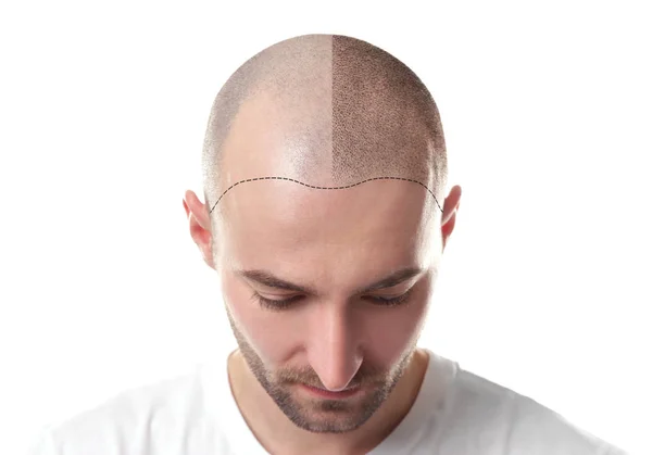 Best Scalp Micropigmentation in Los Angeles: A Game-Changer for Hair Restoration